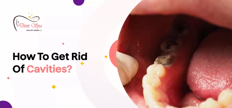 how-to-get-rid-of-cavities